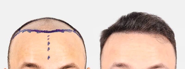 Hair-transplant-turkey-before-and-after
