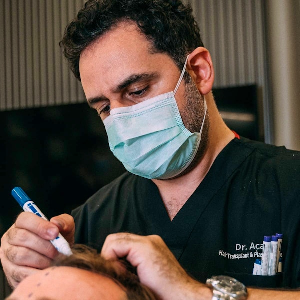 Hair-transplant-turkey-before-and-after-cosmedica-dr-acar