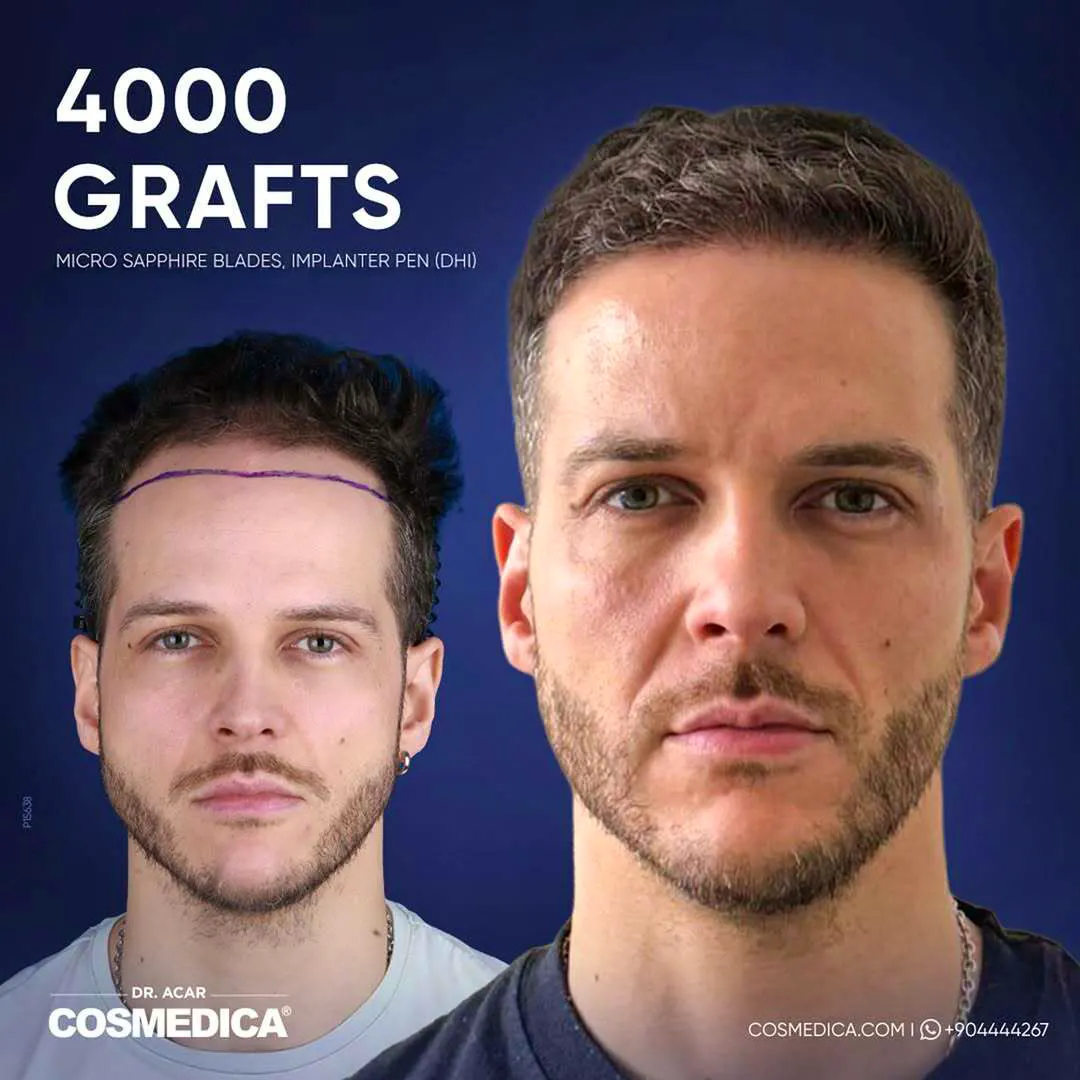 Hair-transplant-before-after