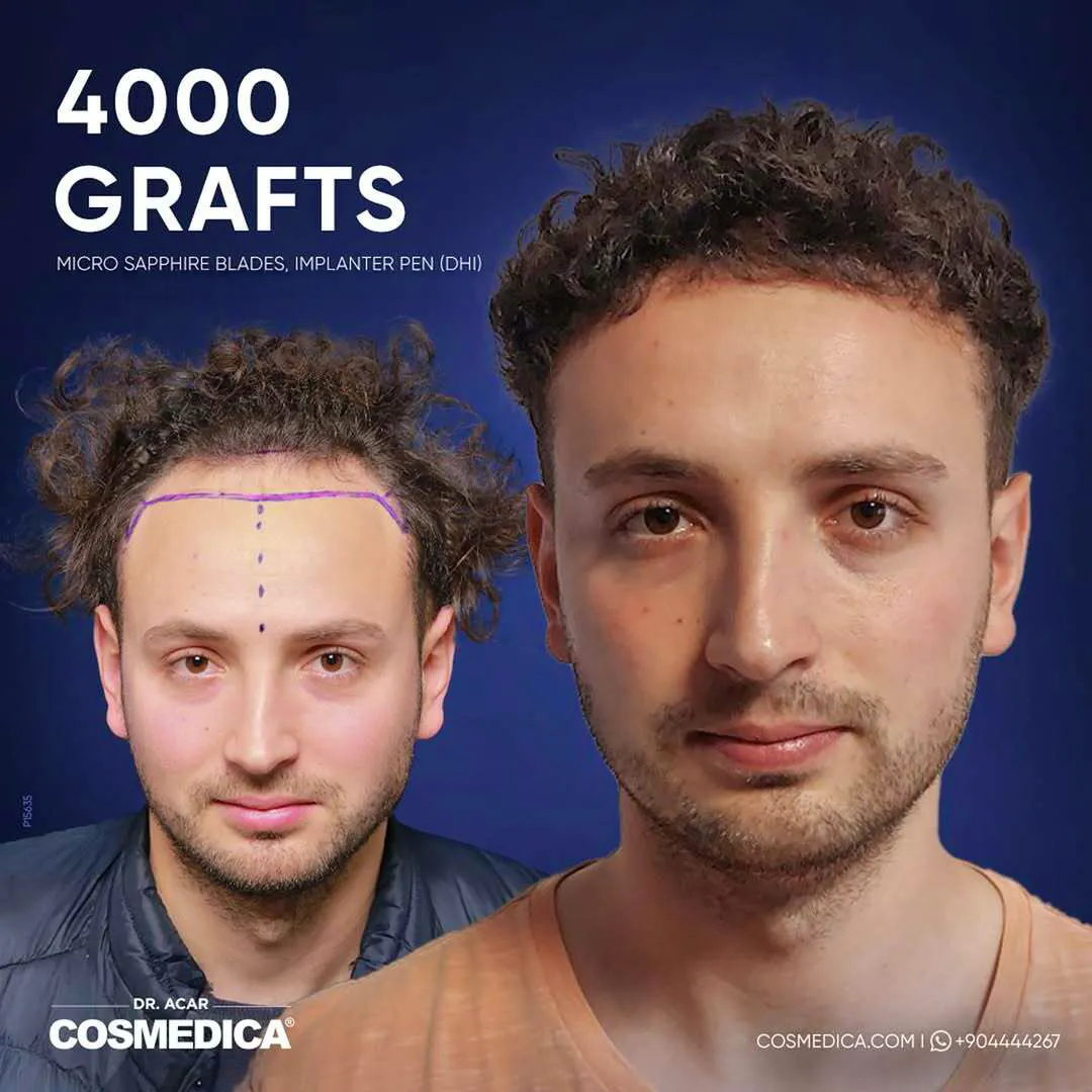 Hair-transplant-before-after-cosmedica
