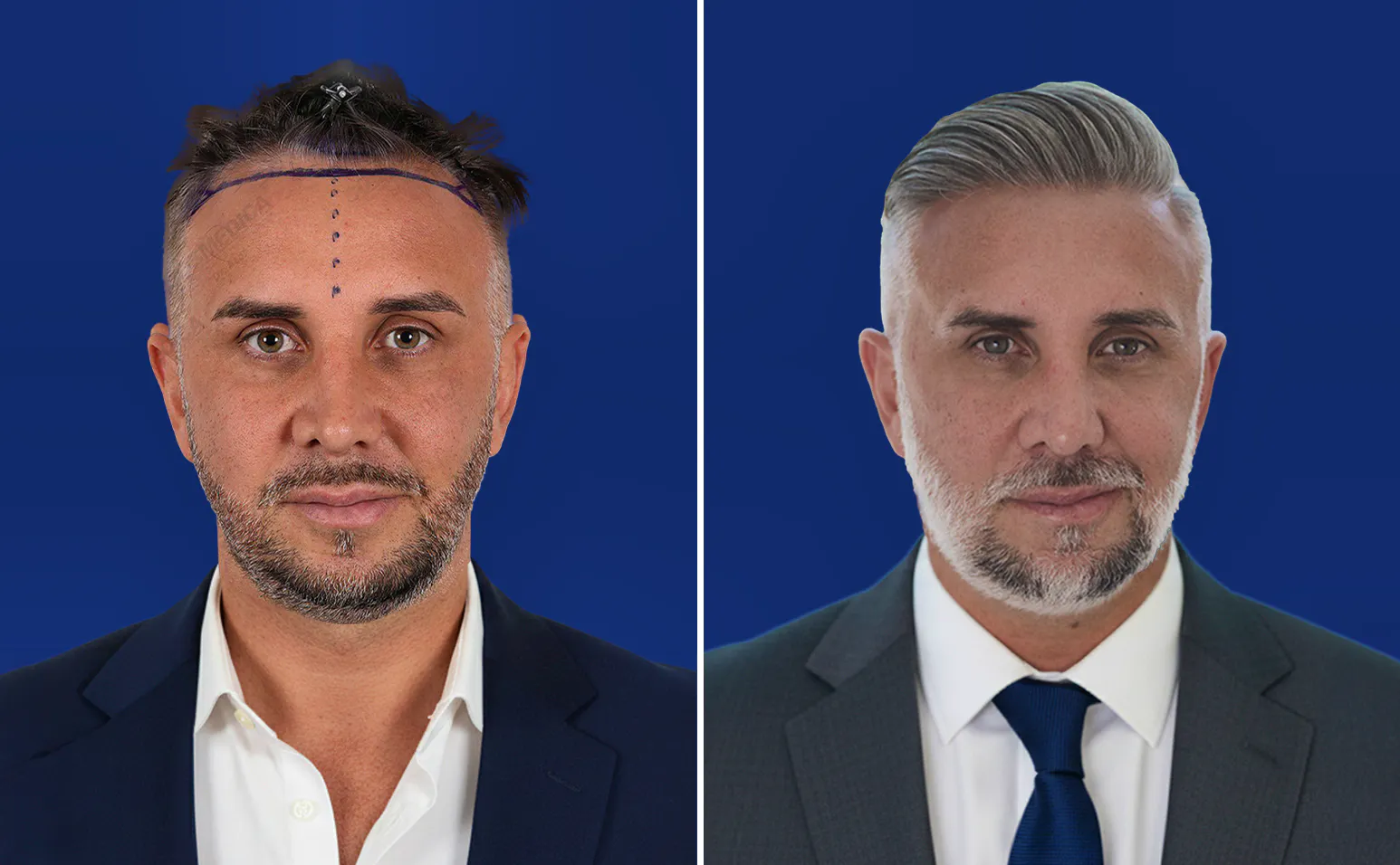 Hair-transplant-turkey-before-after